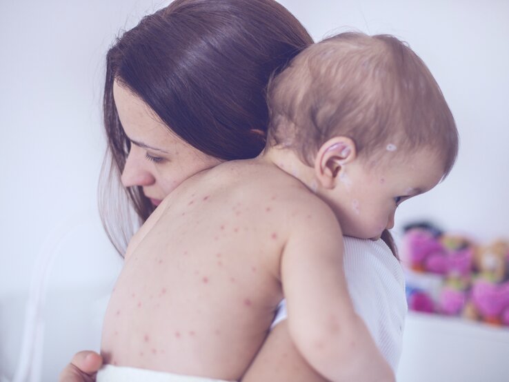 Eine besorgte Mutter hält ihr Baby liebevoll im Arm, das offensichtlich an Windpocken leidet, erkennbar an den vielen roten Pusteln auf seiner Haut. Das Kind liegt mit dem Gesicht nach unten auf der Schulter der Mutter, und beide befinden sich in einem hellen Raum. Die Szene drückt Sorge und mütterliche Fürsorge aus.