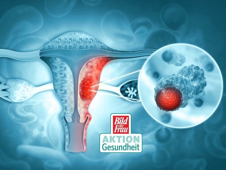 Illustration eines Querschnitts des weiblichen Reproduktionssystems mit Fokus auf den Gebärmutterhals, wo abnormale Zellveränderungen hervorgehoben sind, die Gebärmutterhalskrebs darstellen sollen. Ein vergrößertes Detail zeigt eine veränderte Zelle mit einem ungesunden Zellkern. Das Logo "Bild der Frau AKTION Gesundheit" ist eingefügt, was die Bedeutung der Aufklärung und Vorsorge in Bezug auf Gebärmutterhalskrebs betont. Die Visualisierung soll das Bewusstsein für Krebsvorsorge und Gesundheitschecks erhöhen.