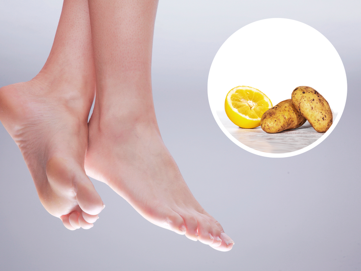 Zitrone und Kartoffeln: Wie diese Hausmittel gegen Hornhaut an den Füßen helfen.