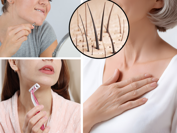 Collage Hirsutismus Zwei Frauen entfernen Gesichtshaare mit Pinzette und Rasierer, daneben Nahaufnahme von Haarwuchs und ältere Frau mit Hand auf Brust.
