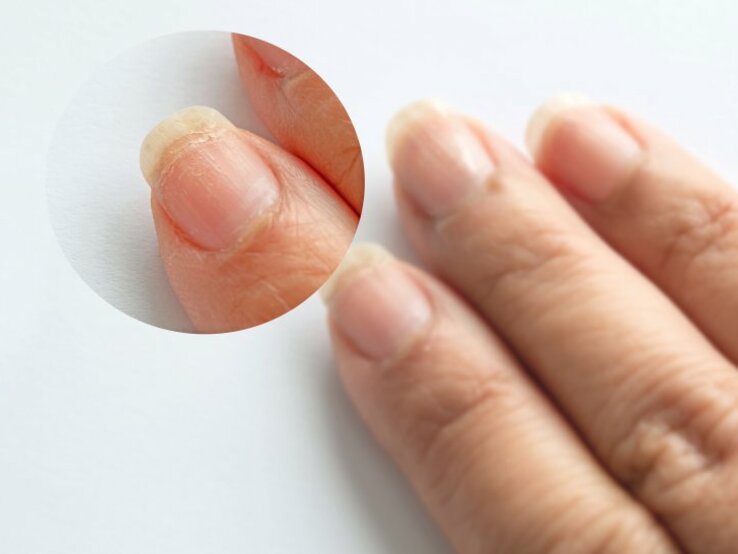 Hand und Close-Up von Fingernagel mit brüchigem Nagel. | © Praewphan – stock.adobe.com