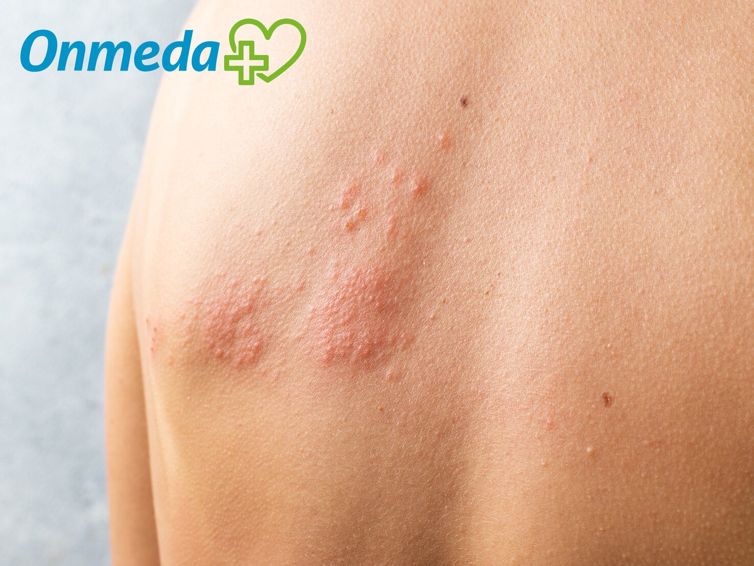 Gürtelrose mehr als nur ein Hautausschlag