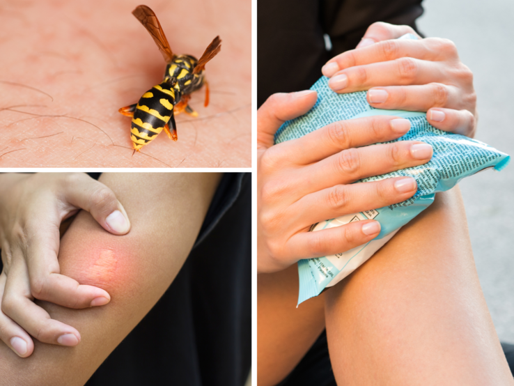 Collage Wespenstich Drei Szenen: Wespenstich auf Haut, gerötete Einstichstelle am Arm und eine Hand, die einen Eisbeutel auflegt.